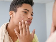 Mon visage est ravagé par de l’acné!