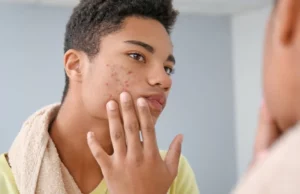 Mon visage est ravagé par de l’acné!