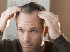 Que faire contre la calvitie ?